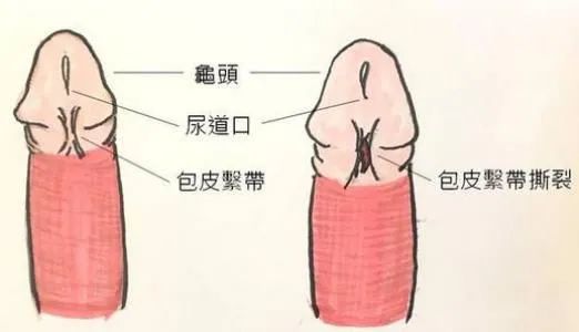 为什么网上教程都建议把延时喷剂喷抹在系带附近